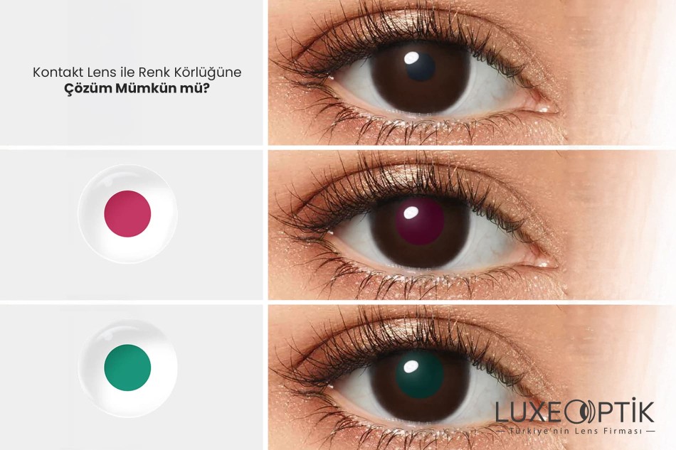 Kontakt Lens ile Renk Körlüğüne Çözüm Mümkün mü? Kontakt Lens ile Renk Körlüğüne Çözüm Mümkün mü?